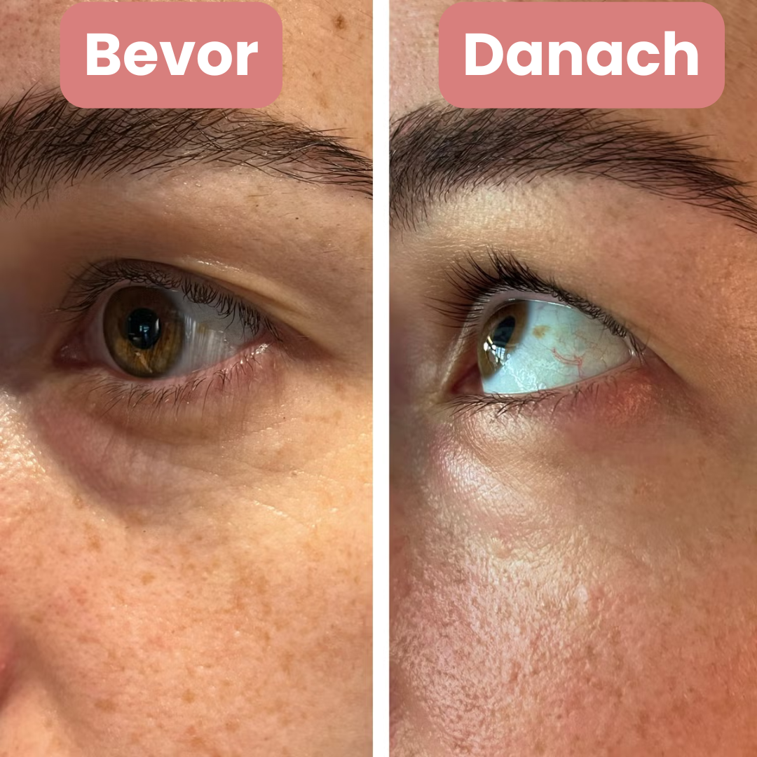 Manial: Mikronadel Pflaster